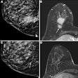 2025 09 09 Radiology Breast Calcifications Thumbnail