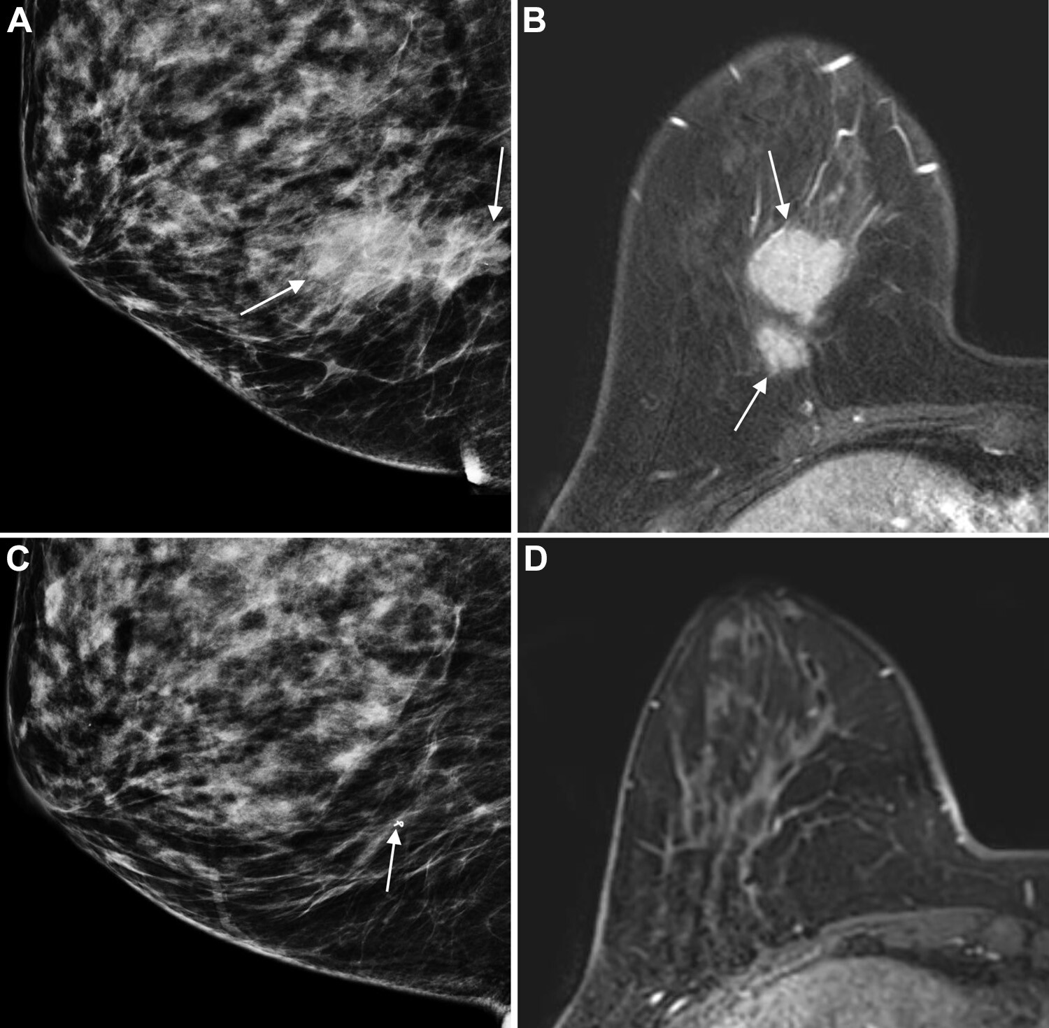 健康・医学 Preneoplasia of the Breast Theranostic Advances in Breast Cancer in Nuclear Medicine