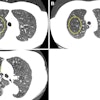 Representative axial images of mild, moderate, and severe emphysema at baseline low-dose CT (LDCT). Participants were categorized as having no emphysema or mild, moderate, or severe emphysema. When present, emphysema was mild if no distinct regions of reduced attenuation were visible on the CT scan, but vascular splaying indicates parenchymal expansion, or if only occasional discrete low-attenuation regions were observed. Moderate emphysema was defined by the presence of identifiable low-attenuation regions affecting less than half of the lung parenchyma, whereas severe emphysema was defined by the presence of identifiable low-attenuation regions that involved more than half of the lung parenchyma. A scoring system from 0 to 3 was applied, corresponding to none, mild, moderate, and severe emphysema, respectively. Yellow circle indicates the extent of emphysema. (A) A 67-year-old man with mild emphysema at baseline LDCT in 2002. Baseline LDCT scan shows vascular splaying, suggesting parenchymal expansion due to emphysema and occasional discrete low-attenuation regions. The participant ultimately died of cardiovascular disease 15.4 years (184.2 months) later. (B) A 69-year-old man with moderate emphysema at baseline LDCT in 2007. The participant died of cardiovascular disease 1.8 years (21.9 months) later. Identifiable low-attenuation regions affected less than half of the lung parenchyma. (C) An 85-year-old woman with severe emphysema at baseline LDCT in 2006. After 5.5 years (65.5 months) of follow-up, the participant died due to chronic obstructive pulmonary disease–related causes. Identifiable low-attenuation regions involved more than half of the lung parenchyma.