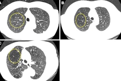 Representative axial images of mild, moderate, and severe emphysema at baseline low-dose CT (LDCT). Participants were categorized as having no emphysema or mild, moderate, or severe emphysema. When present, emphysema was mild if no distinct regions of reduced attenuation were visible on the CT scan, but vascular splaying indicates parenchymal expansion, or if only occasional discrete low-attenuation regions were observed. Moderate emphysema was defined by the presence of identifiable low-attenuation regions affecting less than half of the lung parenchyma, whereas severe emphysema was defined by the presence of identifiable low-attenuation regions that involved more than half of the lung parenchyma. A scoring system from 0 to 3 was applied, corresponding to none, mild, moderate, and severe emphysema, respectively. Yellow circle indicates the extent of emphysema. (A) A 67-year-old man with mild emphysema at baseline LDCT in 2002. Baseline LDCT scan shows vascular splaying, suggesting parenchymal expansion due to emphysema and occasional discrete low-attenuation regions. The participant ultimately died of cardiovascular disease 15.4 years (184.2 months) later. (B) A 69-year-old man with moderate emphysema at baseline LDCT in 2007. The participant died of cardiovascular disease 1.8 years (21.9 months) later. Identifiable low-attenuation regions affected less than half of the lung parenchyma. (C) An 85-year-old woman with severe emphysema at baseline LDCT in 2006. After 5.5 years (65.5 months) of follow-up, the participant died due to chronic obstructive pulmonary disease–related causes. Identifiable low-attenuation regions involved more than half of the lung parenchyma.