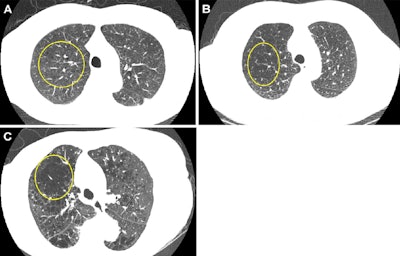 Representative axial images of mild, moderate, and severe emphysema at baseline low-dose CT (LDCT). Participants were categorized as having no emphysema or mild, moderate, or severe emphysema. When present, emphysema was mild if no distinct regions of reduced attenuation were visible on the CT scan, but vascular splaying indicates parenchymal expansion, or if only occasional discrete low-attenuation regions were observed. Moderate emphysema was defined by the presence of identifiable low-attenuation regions affecting less than half of the lung parenchyma, whereas severe emphysema was defined by the presence of identifiable low-attenuation regions that involved more than half of the lung parenchyma. A scoring system from 0 to 3 was applied, corresponding to none, mild, moderate, and severe emphysema, respectively. Yellow circle indicates the extent of emphysema. (A) A 67-year-old man with mild emphysema at baseline LDCT in 2002. Baseline LDCT scan shows vascular splaying, suggesting parenchymal expansion due to emphysema and occasional discrete low-attenuation regions. The participant ultimately died of cardiovascular disease 15.4 years (184.2 months) later. (B) A 69-year-old man with moderate emphysema at baseline LDCT in 2007. The participant died of cardiovascular disease 1.8 years (21.9 months) later. Identifiable low-attenuation regions affected less than half of the lung parenchyma. (C) An 85-year-old woman with severe emphysema at baseline LDCT in 2006. After 5.5 years (65.5 months) of follow-up, the participant died due to chronic obstructive pulmonary disease–related causes. Identifiable low-attenuation regions involved more than half of the lung parenchyma.