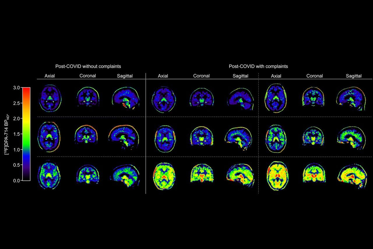 2025 09 12 Long Covid Brain Images Thumbnail