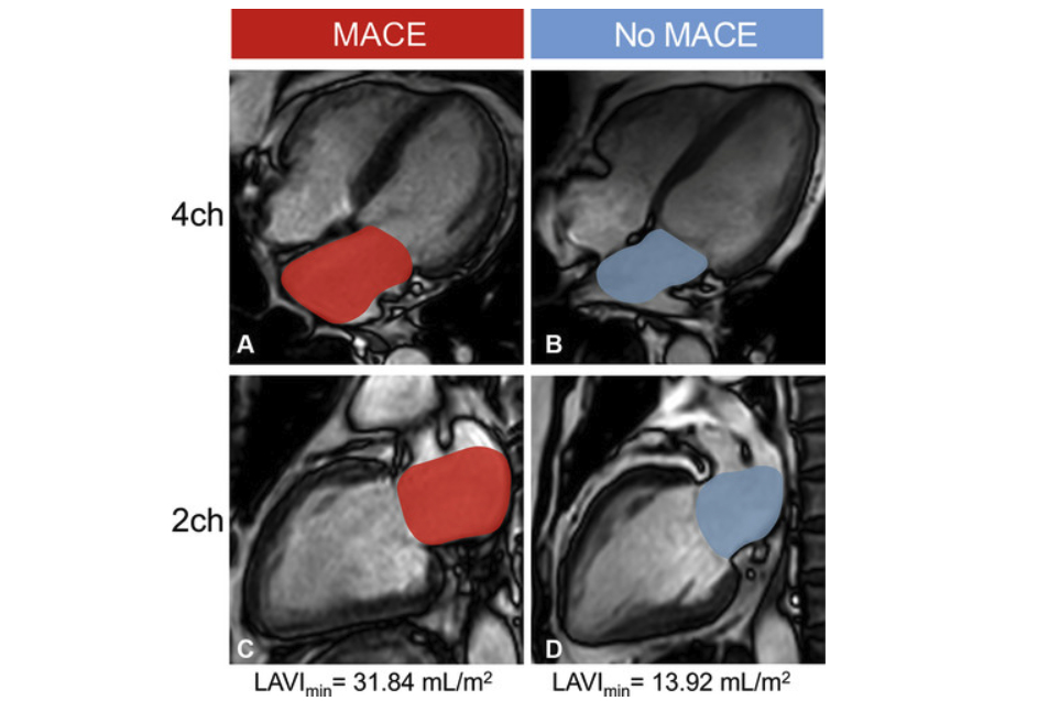 2025 09 16 Ami Mace Study Radiology Thumbnail