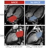 2025 09 16 Ami Mace Study Radiology Thumbnail