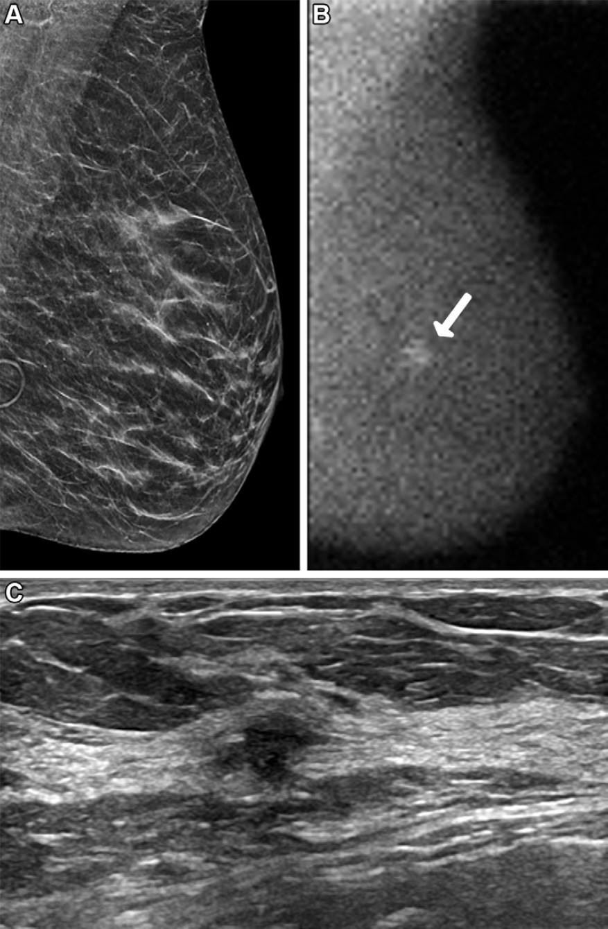 Images in a 62-year-old woman who presented for screening. (A) Image from DBT screening (the synthesized 2D mediolateral oblique view of the left breast is shown) at year on was interpreted as negative and showing heterogeneously dense breast. (B) Image from molecular breast imaging screening (mediolateral oblique view) at year one reveals a 0.9-cm non-mass focal area of uptake in the left breast (arrow). (C) Targeted ultrasound scan (transverse image) shows a suspicious mass in the 3-o&rsquo;clock position of the left breast, 4 cm from the nipple. Ultrasound-guided core biopsy and lumpectomy revealed a 0.9-cm grade 2 invasive ductal carcinoma, an estrogen receptor&ndash;negative, progesterone receptor&ndash;negative, human epidermal growth factor receptor 2&ndash;negative lesion, with two sentinel nodes negative (N0).