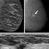 Images in a 62-year-old woman who presented for screening. (A) Image from DBT screening (the synthesized 2D mediolateral oblique view of the left breast is shown) at year on was interpreted as negative and showing heterogeneously dense breast. (B) Image from molecular breast imaging screening (mediolateral oblique view) at year one reveals a 0.9-cm non-mass focal area of uptake in the left breast (arrow). (C) Targeted ultrasound scan (transverse image) shows a suspicious mass in the 3-o’clock position of the left breast, 4 cm from the nipple. Ultrasound-guided core biopsy and lumpectomy revealed a 0.9-cm grade 2 invasive ductal carcinoma, an estrogen receptor–negative, progesterone receptor–negative, human epidermal growth factor receptor 2–negative lesion, with two sentinel nodes negative (N0).