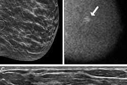 Images in a 62-year-old woman who presented for screening. (A) Image from DBT screening (the synthesized 2D mediolateral oblique view of the left breast is shown) at year on was interpreted as negative and showing heterogeneously dense breast. (B) Image from molecular breast imaging screening (mediolateral oblique view) at year one reveals a 0.9-cm non-mass focal area of uptake in the left breast (arrow). (C) Targeted ultrasound scan (transverse image) shows a suspicious mass in the 3-o’clock position of the left breast, 4 cm from the nipple. Ultrasound-guided core biopsy and lumpectomy revealed a 0.9-cm grade 2 invasive ductal carcinoma, an estrogen receptor–negative, progesterone receptor–negative, human epidermal growth factor receptor 2–negative lesion, with two sentinel nodes negative (N0).