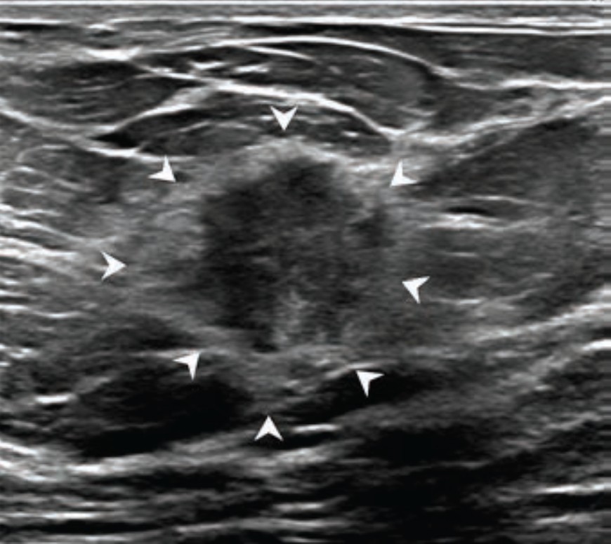 Diagnostic transverse ultrasound image of the left breast in a 64-year-old woman shows irregular hypoechoic nonparallel mass with indistinct margins corresponding to palpable finding, assessed as BI-RADS category 4. Both readers assessed mass as having associated echogenic rind with complete circumferential extent (arrowheads). Ultrasound-guided biopsy of mass yielded diagnosis of invasive ductal carcinoma (intermediate grade, luminal A molecular subtype, no lymphovascular invasion).