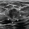 Diagnostic transverse ultrasound image of the left breast in a 64-year-old woman shows irregular hypoechoic nonparallel mass with indistinct margins corresponding to palpable finding, assessed as BI-RADS category 4. Both readers assessed mass as having associated echogenic rind with complete circumferential extent (arrowheads). Ultrasound-guided biopsy of mass yielded diagnosis of invasive ductal carcinoma (intermediate grade, luminal A molecular subtype, no lymphovascular invasion).