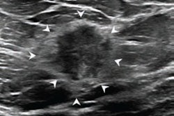 Diagnostic transverse ultrasound image of the left breast in a 64-year-old woman shows irregular hypoechoic nonparallel mass with indistinct margins corresponding to palpable finding, assessed as BI-RADS category 4. Both readers assessed mass as having associated echogenic rind with complete circumferential extent (arrowheads). Ultrasound-guided biopsy of mass yielded diagnosis of invasive ductal carcinoma (intermediate grade, luminal A molecular subtype, no lymphovascular invasion).