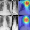 Saliency maps using Grad-CAM++ (E and H) show the model’s point of interest in chest radiographs (C and F) of patients with achalasia. The model’s point of interest is highlighted with red, yellow, and green. In both the upper and lower panels (E and H), the point of interest is located in a region around the upper esophagus that corresponds to an air esophagogram and/or air-fluid level in the esophagus in the barium esophagogram (D and G).