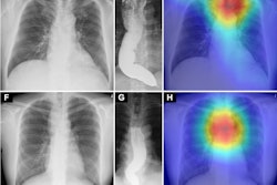 Saliency maps using Grad-CAM++ (E and H) show the model’s point of interest in chest radiographs (C and F) of patients with achalasia. The model’s point of interest is highlighted with red, yellow, and green. In both the upper and lower panels (E and H), the point of interest is located in a region around the upper esophagus that corresponds to an air esophagogram and/or air-fluid level in the esophagus in the barium esophagogram (D and G).