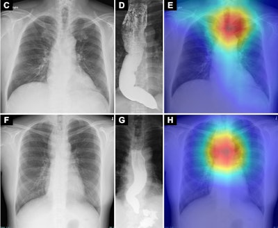 Saliency maps using Grad-CAM++ (E and H) show the model’s point of interest in chest radiographs (C and F) of patients with achalasia. The model’s point of interest is highlighted with red, yellow, and green. In both the upper and lower panels (E and H), the point of interest is located in a region around the upper esophagus that corresponds to an air esophagogram and/or air-fluid level in the esophagus in the barium esophagogram (D and G).