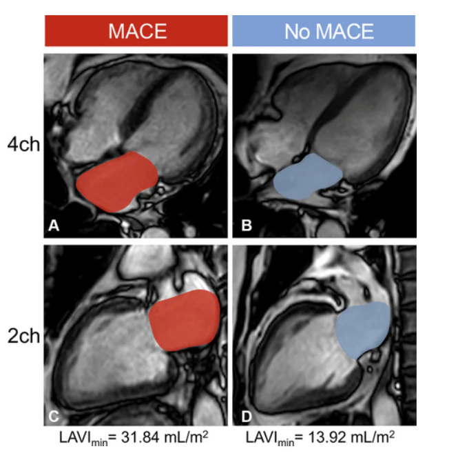 Cardiovascular Risk Mace Cardiac MRI measures aid in predicting future MACE after heart attack ...