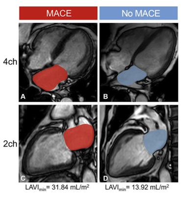 Cardiac MRI cine images in the (A, B) four-chamber (4ch) and (C, D) two-chamber (2ch) views illustrate contouring (red and blue areas) for measurement of left atrial (LA) minimum volume index (LAVImin) at end diastole in two representative participants with acute myocardial infarction (AMI). The LA appendage and pulmonary veins were not considered part of the LA volume. (A, C) Images in a 76-year-old man with a history of coronary artery disease who underwent contrast-enhanced cardiac MRI 4 days after AMI and experienced a major adverse cardiovascular event (MACE), in this case death, during follow-up. LAVImin was 31.84 mL/m2 in this participant. (B, D) Images in a 38-year-old man with a history of angina who underwent contrast-enhanced cardiac MRI 4 days after AMI and did not experience MACE during follow-up. LAVImin was 13.92 mL/m2 in this participant.