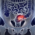 Colorectal Cancer