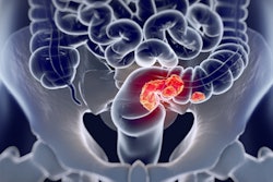 Colorectal Cancer