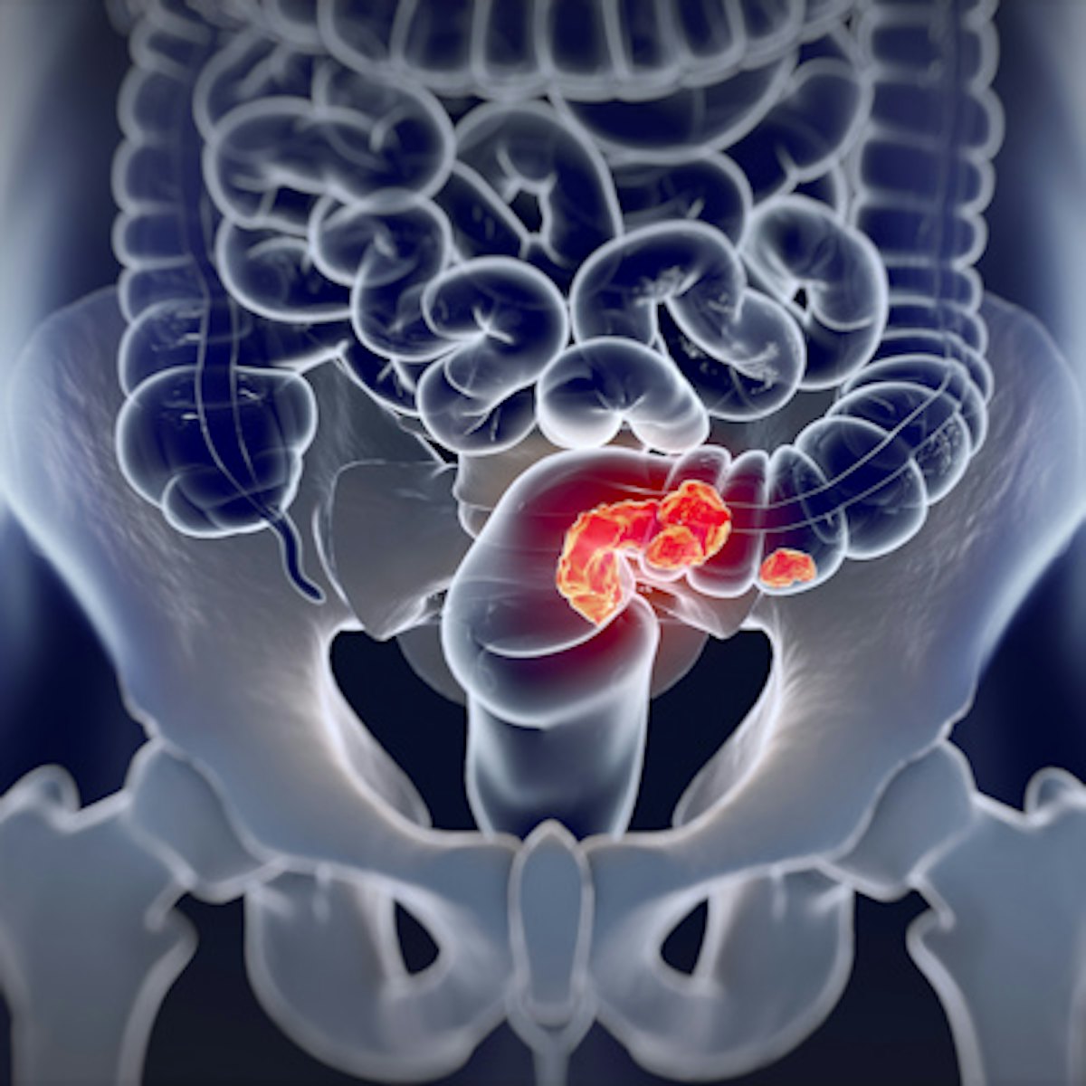 5-year CTC screening interval is appropriate for colorectal cancer