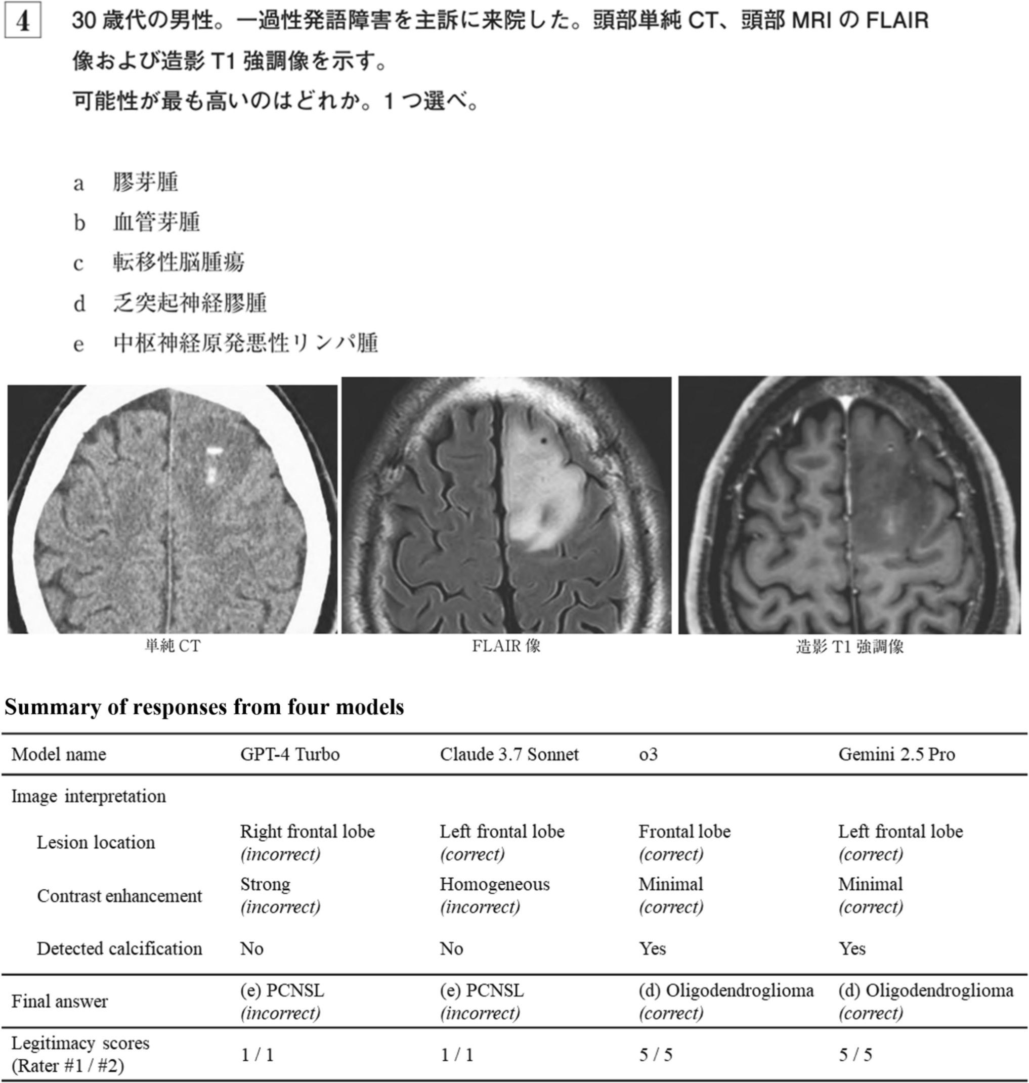 Question 4 from the Japan Diagnostic Radiology Board Examination 2024, representing a clinical scenario of a man in his 30s presented with transient dysphasia. The question asks to identify the most probable diagnosis from the following options: (a) glioblastoma, (b) hemangioblastoma, (c) metastatic brain tumor, (d) oligodendroglioma, and (e) primary central nervous system lymphoma (PCNSL). The correct answer is (d) oligodendroglioma. The figure also includes a summary of responses from four large language models, along with their legitimacy scores rated by diagnostic radiologists.