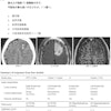 Question 4 from the Japan Diagnostic Radiology Board Examination 2024, representing a clinical scenario of a man in his 30s presented with transient dysphasia. The question asks to identify the most probable diagnosis from the following options: (a) glioblastoma, (b) hemangioblastoma, (c) metastatic brain tumor, (d) oligodendroglioma, and (e) primary central nervous system lymphoma (PCNSL). The correct answer is (d) oligodendroglioma. The figure also includes a summary of responses from four large language models, along with their legitimacy scores rated by diagnostic radiologists.