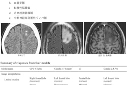 Question 4 from the Japan Diagnostic Radiology Board Examination 2024, representing a clinical scenario of a man in his 30s presented with transient dysphasia. The question asks to identify the most probable diagnosis from the following options: (a) glioblastoma, (b) hemangioblastoma, (c) metastatic brain tumor, (d) oligodendroglioma, and (e) primary central nervous system lymphoma (PCNSL). The correct answer is (d) oligodendroglioma. The figure also includes a summary of responses from four large language models, along with their legitimacy scores rated by diagnostic radiologists.