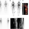 I-123 MIBG–negative and F-18 MFBG–positive scans showing multiple lesions in 9-year-old male with relapsed high-risk, multiple-relapse neuroblastoma (stage IV disease) receiving chemoimmunotherapy. (A) I-123 MIBG uptake is seen in lower lumbar vertebrae (arrows). Positive uptake with F-18 MFBG PET (B; black arrows) in skull, spine, pelvic bones, femora, and left tibia (B and C; blue and white arrows). Bone marrow biopsy was positive for disease. Follow-up I-123 MIBG imaging (D; left) and spine MRI (D; right) performed six weeks later showed diffuse disease in skull and spine, corresponding to F-18 MFBG–avid sites.