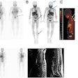 I-123 MIBG–negative and F-18 MFBG–positive scans showing multiple lesions in 9-year-old male with relapsed high-risk, multiple-relapse neuroblastoma (stage IV disease) receiving chemoimmunotherapy. (A) I-123 MIBG uptake is seen in lower lumbar vertebrae (arrows). Positive uptake with F-18 MFBG PET (B; black arrows) in skull, spine, pelvic bones, femora, and left tibia (B and C; blue and white arrows). Bone marrow biopsy was positive for disease. Follow-up I-123 MIBG imaging (D; left) and spine MRI (D; right) performed six weeks later showed diffuse disease in skull and spine, corresponding to F-18 MFBG–avid sites.