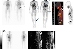 I-123 MIBG–negative and F-18 MFBG–positive scans showing multiple lesions in 9-year-old male with relapsed high-risk, multiple-relapse neuroblastoma (stage IV disease) receiving chemoimmunotherapy. (A) I-123 MIBG uptake is seen in lower lumbar vertebrae (arrows). Positive uptake with F-18 MFBG PET (B; black arrows) in skull, spine, pelvic bones, femora, and left tibia (B and C; blue and white arrows). Bone marrow biopsy was positive for disease. Follow-up I-123 MIBG imaging (D; left) and spine MRI (D; right) performed six weeks later showed diffuse disease in skull and spine, corresponding to F-18 MFBG–avid sites.
