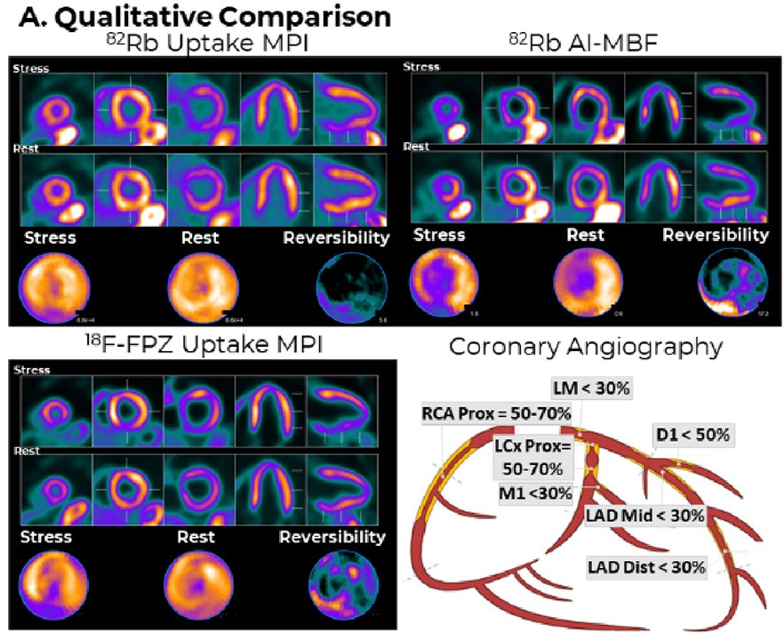 AI boosts cardiac PET imaging | AuntMinnie