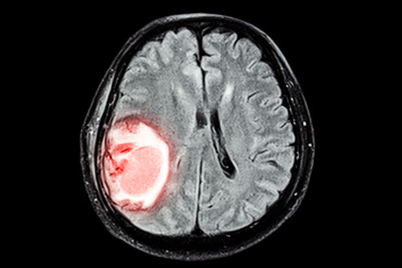 Mri Brain Disease2 Thumbnail