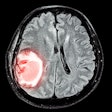 Mri Brain Disease2 Thumbnail