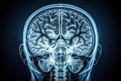 Mri Scan Brain