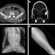 Representative injuries in patients from the mass casualty incident of October 7, 2023. (A) Axial CT scan at the pelvic level in a 34-year-old male patient shows multiple shrapnel fragments in the pelvis, resulting in fractures of the pelvic bones and lumbar vertebrae (not visible on this image). (B) Coronal reconstruction of a head CT scan in a 20-year-old male patient shows penetrating trauma to the left eyeball with a retained bullet in the orbital cavity. (C) Radiograph of a fetus delivered by emergency cesarean section from a critically injured mother shows a left pneumothorax and catheter in place. (D) Radiograph in a 25-year-old female patient shows a comminuted fracture in the tibial metaphysis with fragment displacement and multiple bony fragments in the surrounding soft tissues.