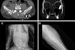 Representative injuries in patients from the mass casualty incident of October 7, 2023. (A) Axial CT scan at the pelvic level in a 34-year-old male patient shows multiple shrapnel fragments in the pelvis, resulting in fractures of the pelvic bones and lumbar vertebrae (not visible on this image). (B) Coronal reconstruction of a head CT scan in a 20-year-old male patient shows penetrating trauma to the left eyeball with a retained bullet in the orbital cavity. (C) Radiograph of a fetus delivered by emergency cesarean section from a critically injured mother shows a left pneumothorax and catheter in place. (D) Radiograph in a 25-year-old female patient shows a comminuted fracture in the tibial metaphysis with fragment displacement and multiple bony fragments in the surrounding soft tissues.