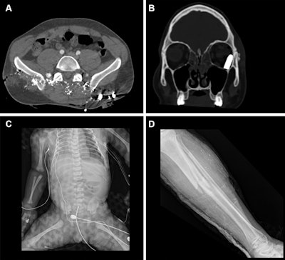 Representative injuries in patients from the mass casualty incident of October 7, 2023. (A) Axial CT scan at the pelvic level in a 34-year-old male patient shows multiple shrapnel fragments in the pelvis, resulting in fractures of the pelvic bones and lumbar vertebrae (not visible on this image). (B) Coronal reconstruction of a head CT scan in a 20-year-old male patient shows penetrating trauma to the left eyeball with a retained bullet in the orbital cavity. (C) Radiograph of a fetus delivered by emergency cesarean section from a critically injured mother shows a left pneumothorax and catheter in place. (D) Radiograph in a 25-year-old female patient shows a comminuted fracture in the tibial metaphysis with fragment displacement and multiple bony fragments in the surrounding soft tissues.