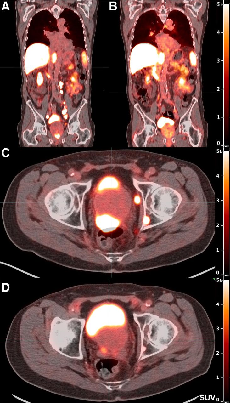 Burden of PSMA-expressing prostate cancer before and after treatment with two cycles of Lu-177 PSMA-617. (A and B) Reduction in overall disease burden is evident after treatment. Avidity of patient&rsquo;s primary prostate tumor and his osseous metastasis shown before (C) and after (D) treatment.