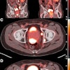 Burden of PSMA-expressing prostate cancer before and after treatment with two cycles of Lu-177 PSMA-617. (A and B) Reduction in overall disease burden is evident after treatment. Avidity of patient’s primary prostate tumor and his osseous metastasis shown before (C) and after (D) treatment.