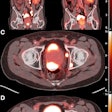Burden of PSMA-expressing prostate cancer before and after treatment with two cycles of Lu-177 PSMA-617. (A and B) Reduction in overall disease burden is evident after treatment. Avidity of patient’s primary prostate tumor and his osseous metastasis shown before (C) and after (D) treatment.
