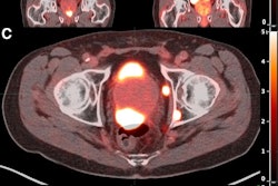 Burden of PSMA-expressing prostate cancer before and after treatment with two cycles of Lu-177 PSMA-617. (A and B) Reduction in overall disease burden is evident after treatment. Avidity of patient’s primary prostate tumor and his osseous metastasis shown before (C) and after (D) treatment.