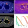An example of a typical BgRT plan: A) PET scan on diagnostic PET/CT and B) X1 PET-Linac for patient #15 with a PET avid rib metastasis with GTV size= 3.1 cc, PTV = GTV + 5mm, BTZ (biological tracking zone) = PTV + 5 mm, AC = 14.33 kBq/mL and NTS = 21.04. Red, magenta, and green contours represent GTV, PTV, and BTZ. C) Dose distribution and D) bounded-DVH of a BgRT plan are displayed for the same patient. The bounded Dose-Volume Histogram (DVH) models variations in BgRT delivery, encompassing fluctuation in target background signal variation, target localization and dose delivery uncertainties.