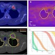 An example of a typical BgRT plan: A) PET scan on diagnostic PET/CT and B) X1 PET-Linac for patient #15 with a PET avid rib metastasis with GTV size= 3.1 cc, PTV = GTV + 5mm, BTZ (biological tracking zone) = PTV + 5 mm, AC = 14.33 kBq/mL and NTS = 21.04. Red, magenta, and green contours represent GTV, PTV, and BTZ. C) Dose distribution and D) bounded-DVH of a BgRT plan are displayed for the same patient. The bounded Dose-Volume Histogram (DVH) models variations in BgRT delivery, encompassing fluctuation in target background signal variation, target localization and dose delivery uncertainties.
