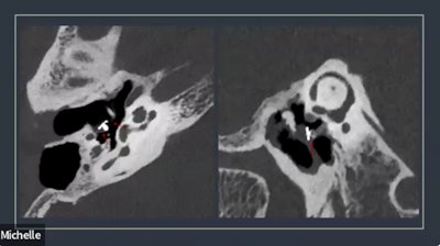 Temporal bone imaging using photon counting CT illuminated the ossicular implant.