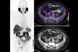 2025 10 09 Jnumed Psma Pet Vs Na F Pet Thumbnail