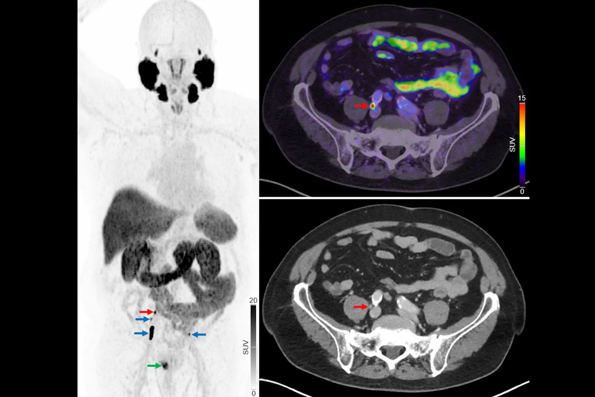 Advanced Imaging Boosts Cancer Treatment Outcomes, Studies Reveal