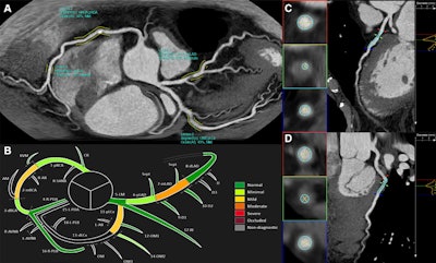 AI reconstruction. (A) Two-dimensional overview of the whole coronary tree obtained from CCTA, as reconstructed by the software. Areas of stenosis are highlighted and visualized together with an esteem of lumen diameter and area reduction, as well as the corresponding CAD-RADS stenosis grade. (B) In another reconstruction, all 18 segments are displayed and colored based on the esteemed CAD-RADS stenosis grade. (C, D) The software provides additional images for each detected lesion, with specific reconstructions to show the reader the exact lumen diameter and stenosis grade. CAD-RADS = Coronary Artery Disease Reporting and Data System, CCTA = coronary CT angiography. Images and caption courtesy of the RSNA.