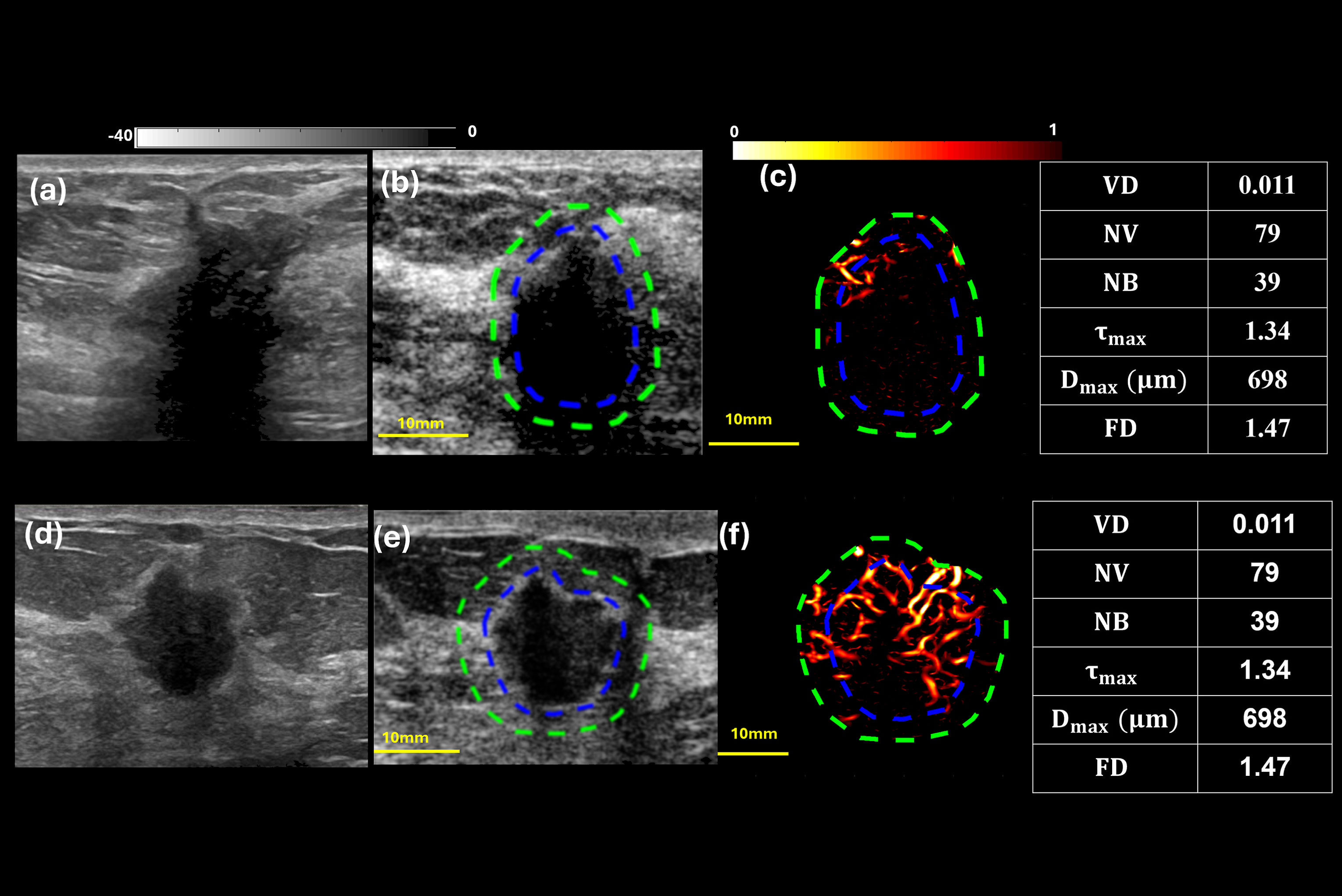 2025 10 14 Breast Qhdmi Ultrasound Thumbnail