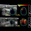 2025 10 14 Breast Qhdmi Ultrasound Thumbnail