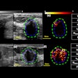 2025 10 14 Breast Qhdmi Ultrasound Thumbnail