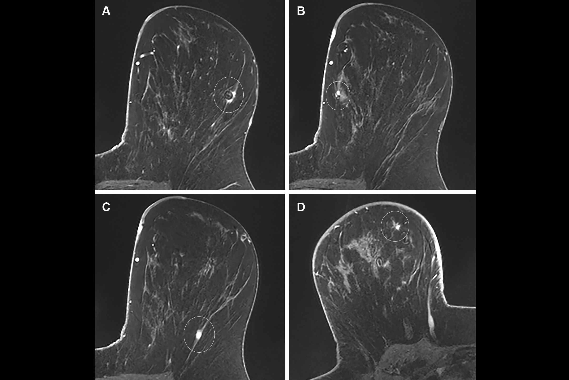 2025 10 14 Radiology Preop Mri Birads Thumbnail