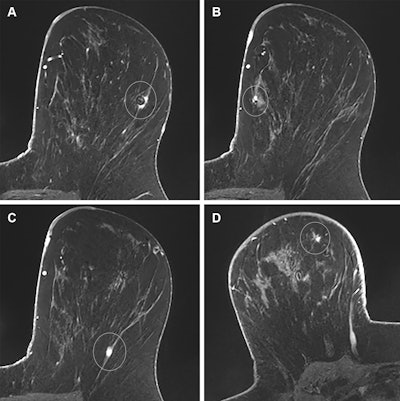 Images in a 39-year-old woman with a remote history of right breast cancer and a new diagnosis of multicentric left breast cancer; this case illustrates appropriate auditing of true- and false-positive results. (A) Axial T1-weighted postcontrast image from preoperative breast MRI shows a small invasive mammary carcinoma with biopsy clip susceptibility artifact (circle) in the lateral left breast that was diagnosed before MRI. (B) Axial T1-weighted postcontrast image from the same examination reveals a smaller invasive mammary carcinoma with biopsy clip susceptibility artifact (circle) in the medial left breast that was also diagnosed before MRI. For the purpose of auditing in this study, the larger of these two malignancies was considered the index malignancy. (C) Axial T1-weighted postcontrast image from the same examination demonstrates an additional small mass in the posterior aspect of the left breast (circle). It was described as suspicious, and a third focus of invasive mammary carcinoma was diagnosed at MRI-guided biopsy. This pathologic result was audited as a true-positive ipsilateral finding. (D) Axial T1-weighted postcontrast image from the same examination shows a fourth mass in the contralateral right breast (circle), which was also described as suspicious. MRI-guided biopsy yielded benign fat necrosis and stromal fibrosis, which was audited as a false-positive contralateral finding.
